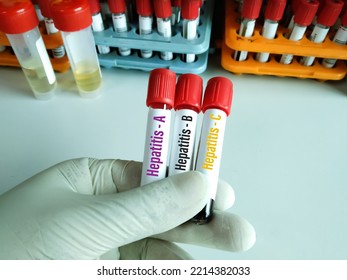 Blood Samples Tube With Sample For Hepatitis Virus Test (Hepatitis A, Hepatitis B, Hepatitis C)