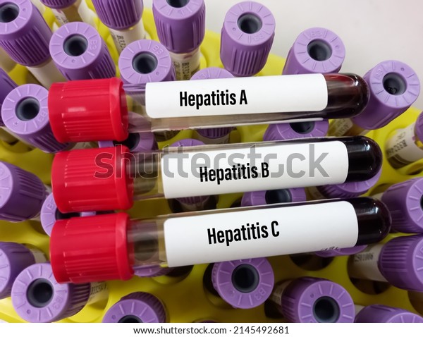 Blood samples tube with sample\
for hepatitis virus test (Hepatitis A, Hepatitis B, Hepatitis\
C)