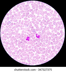 Blood Smear Form Sepsis.septicemia Can Progress To Sepsis.