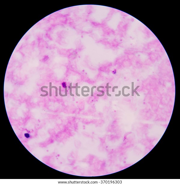 Blood Smear Malaria Parasite Positive Thick Stock Photo 370196303 ...