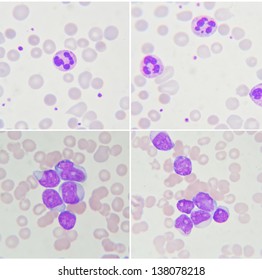 Blood Smear Show Neutrophil Leukemia Cells Stock Photo 138078218 ...