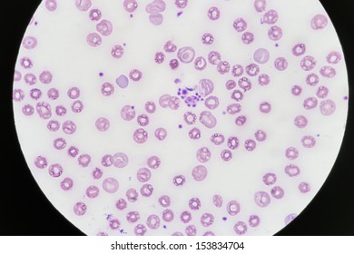 Blood smear show platelet clumping