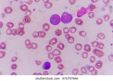 Blood Smear Showing Blast Cells Leukemia Stock Photo 676707127 ...