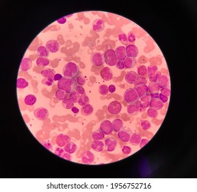 Blood Smear Showing Under Microscopeleukemia Cancer Stock Photo ...