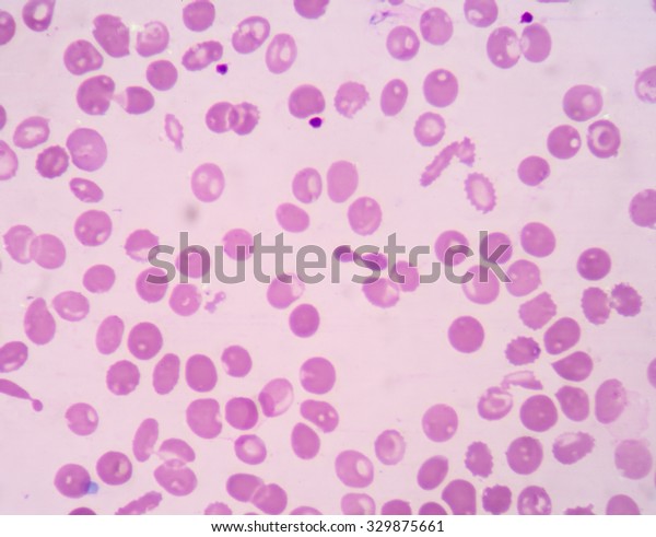 Blood Smear Thalassemia Showing Hypochromiaschistocytenrctarget Cells