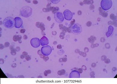 Blood Smear Under Microscopy Showing On Adult Acute Myeloid Leukemia (AML) Is A Type Of Cancer In Which The Bone Marrow Makes Abnormal Myeloblasts A Type Of White Blood Cell.