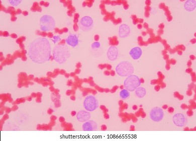 Blood Smear Under Microscopy Showing On Adult Acute Myeloid Leukemia (AML) Is A Type Of Cancer In Which The Bone Marrow Makes Abnormal Myeloblasts A Type Of White Blood Cell.