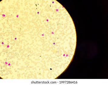 Blood Smear Under Microscopy Showing On Adult Acute Myeloid Leukemia (AML) Is A Type Of Cancer,thrombocytopenia,increase Blast Cell