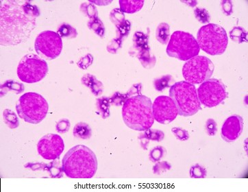 Blood Smear Under Microscopy Showing On Adult Acute Myeloid Leukemia (AML) Is A Type Of Cancer In Which The Bone Marrow Makes Abnormal Myeloblasts A Type Of White Blood Cell.