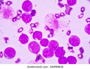 Blood Smear Under Microscopy Showing On Adult Acute Myeloid Leukemia (AML) Is A Type Of Cancer In Which The Bone Marrow Makes Abnormal Myeloblasts A Type Of White Blood Cell.