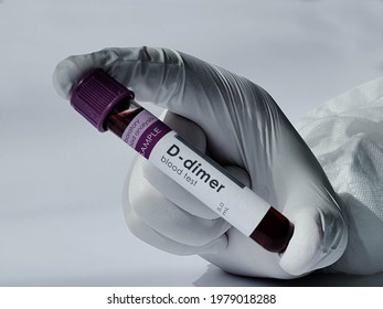 Blood Test For D Dimer Strong Predictor Of Mortality In Those Suffering From COVID 19. Fibrin Degradation Product Present In Blood After Blood Clot