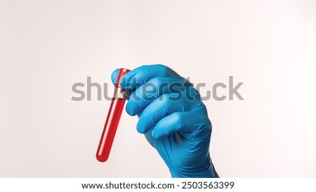 Blood test for the monkey pox virus. A laboratory assistant holds a test tube with blood in his hands, a suspicion of the monkey pox virus. The concept of the smallpox pandemic and viral infection