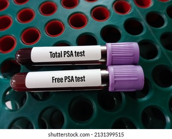 Blood test tube with sample for PSA (Total and Free) test. Prostate specific antigen, diagnosis of prostate cancer