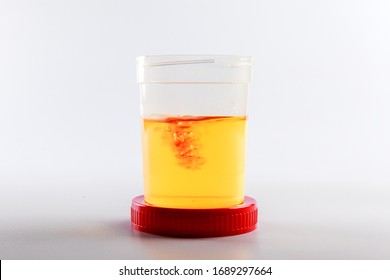 blood in urine analysis as an idea of urogenital system disease and prostate cancer. disease based on the result of a urine test