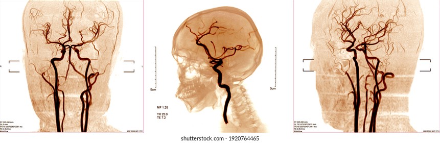 blood vessels x-ray images in the brain for diagnose cerebrovascular disease or hemorrhagic stroke.