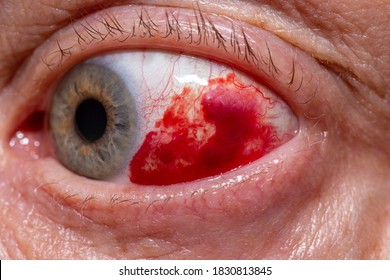 Bloodshot Eye Subconjunctival Hemorrhage In Left Eye 