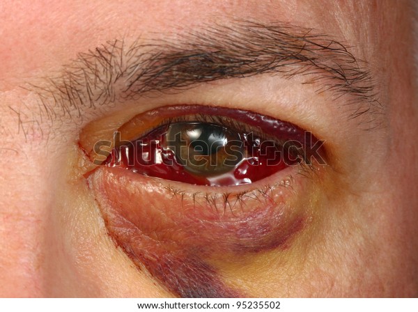 Bloody Eye After Detached Retina Surgery Stock Photo Edit Now