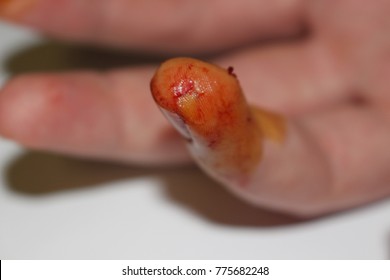 bloody finger from an accident cutting vegetables 