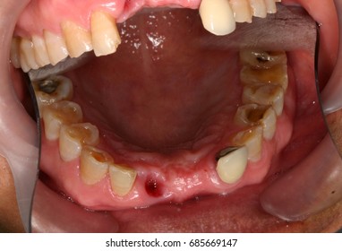 Bloody Hole Gums In The Patient's Mouth Full With Saliva