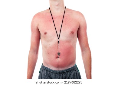 Blotchy Sunburn From Poor Sunscreen Application
