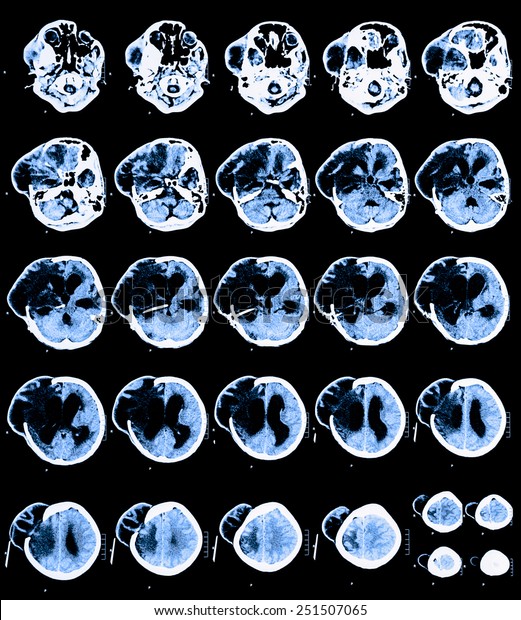 Blue Brain CT Scan image is
divided into different levels. To detect abnormalities of the
brain. Due to formation of oedemas area right side of ventricles
brain.