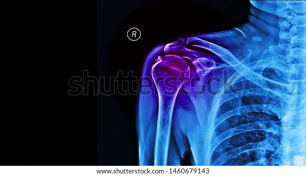 Blue tone of plain\
radiograph of human shoulder after accident.The film shown calcific\
tendinitis of rotator cuff.Patient came to hospital with severe\
pain. Medical concept.