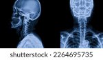Blue tone radiograph on dark background in hospital.Doctor used xray for diagnosis of the illness of patient.X-ray c-spine in AP and lateral view in orthopedic unit inside hospital.Normal radiology.
