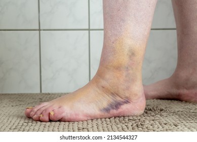 Blue Woman's Foot With A Broken Ankle And Fibula