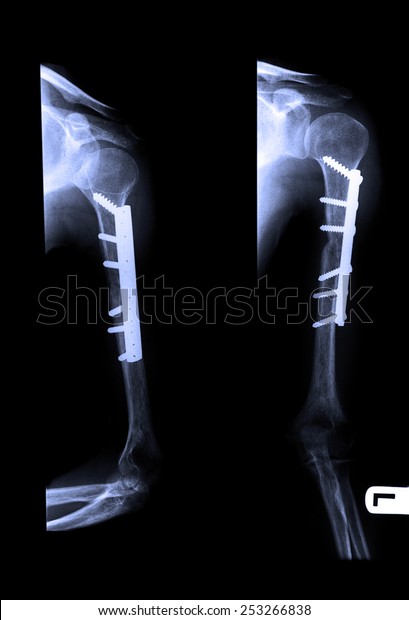 Blue X-ray forearm fractures to reinforce the left\
arm and fastened with screw for treatment. The cause of the\
accident with the car.