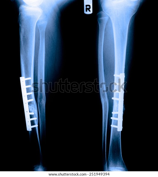Blue X-ray leg bone fracture of right side leg.\
Treated by inserting a steel bone. The cause of the motorcycle\
collided with a car.