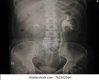 Blur Special Examination I.V.P: Show a 4mm.calcified stone at distal Lt. ureter.Both kidneys show good excretion.A 4mm.Lt.distal UC cause obstruction and moderate hydronephrosis Lt.kidney - Shutterstock ID 761552164