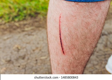 Blur Of Wound A Knee Flows Blood Is Red Cut On Skin. Medical Concept.