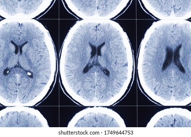 Blurred Background Of Computerized Tomography Of Head. Closeup Of Xray Film For Doctor Examination. Concept Of Medical Pattern, Section Of Brain.