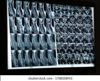 Blurred Image Of Black And White CT Scan Of Human Spine On Light Board