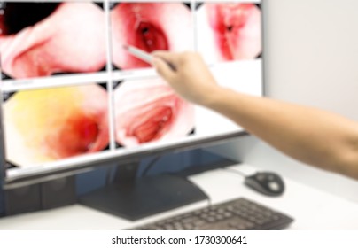 Blurred image medical image Gastrointestinal endoscopic examination image showing acute on chronic gastritis.Medical healthcare concept.