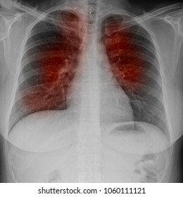 Blurred Pulmonary Tuberculosis . Chest X-Ray : Right lung atelectasis and infiltration and effusion due to Mycobacterium Tuberculosis infection. Medical and healthcare concept.