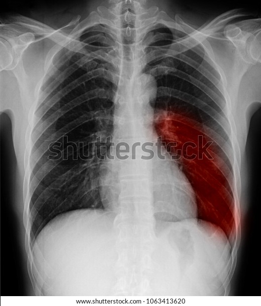 Blurred Pulmonary Tuberculosis Tb Chest Xray Stock Photo 1063413620 ...