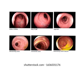  Blurred and selective focus Colonoscopy Anal canal,rectum,sigmoid,descending colon,transverse colon,ascending colon+cecum normal.Medical healthcare concept.