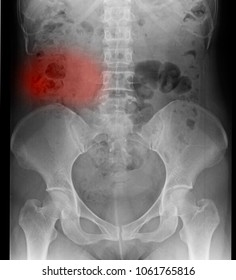 Blurred X Ray Kidney Stones Pain Stock Photo Edit Now 1061765816