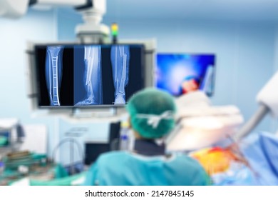 Blurry Close-Up Traumatology Orthopedic Surgery Hospital Emergency Operating Room For The Leg Broken Operation Photo.,Medical Health Concept.