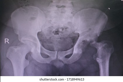 Blurry Closeup X-ray Both Hips(AP)Showing Disappearance Left Femor Heard And Irregular Acetabulum With Osteoporosis.Normal Right Hip Joint Space,Impression Tuberculosis.Medical Healthcare Concept.