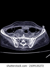 Blurry Film CT Scan Lower Abdomen Severe Hydronephrosis Rt Kidney With Distal Ureteric Obstruction, May Due To Infiltrative Tumor At Rt Parametrium ( CA Cervix) Medical Image Concept.