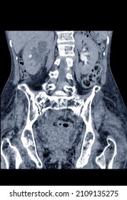 Blurry Film CT Scan Lower Abdomen Severe Hydronephrosis Rt Kidney With Distal Ureteric Obstruction, May Due To Infiltrative Tumor At Rt Parametrium ( CA Cervix) Medical Image Concept.