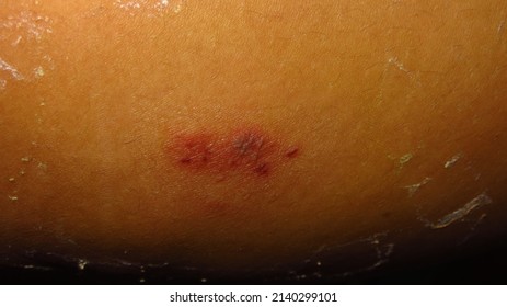 7,630 Rotting skin Images, Stock Photos & Vectors | Shutterstock