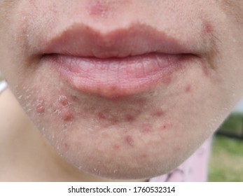 Blurry Image Of Face Or Mouth Woman, The Face Asian Woman Is Allergic Some Cosmetics Or Dust That Makes Her Face Allergy Rash Or Allergic To Mask, Chin Allergy Rash, Health Care Concept