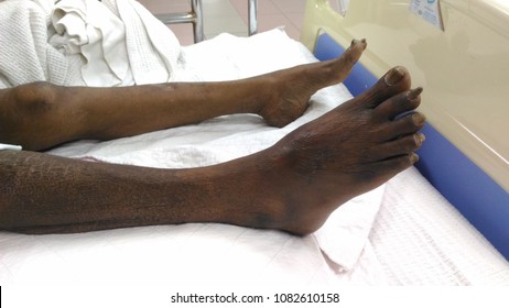 20 Critical limb ischaemia Images, Stock Photos & Vectors | Shutterstock