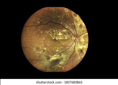 Blurry View inside human eye disorders showing retina, optic nerve and macula Severe age-related macular degeneration.Medical image  Retina Abnormal isolated on black  background