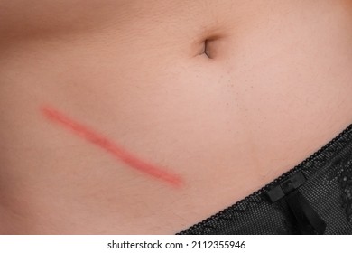 Body abdomen skin scar after removal of appendicitis surgery consequences of surgery, close-up.