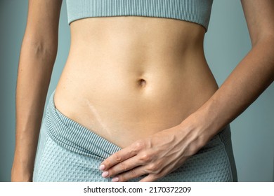 Body abdomen skin scar after appendicitis removal on a woman, surgery consequences of surgery.