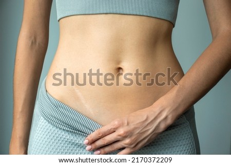 Body abdomen skin scar after appendicitis removal on a woman, surgery consequences of surgery. Imagine de stoc © 